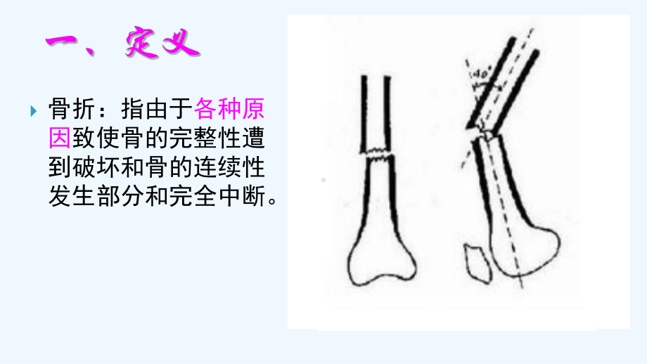 骨折患者的康复护理1课件.ppt_第2页