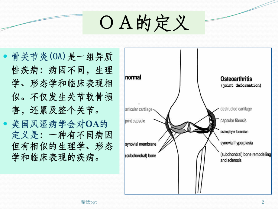 骨关节炎-最新PPT课件.ppt_第2页