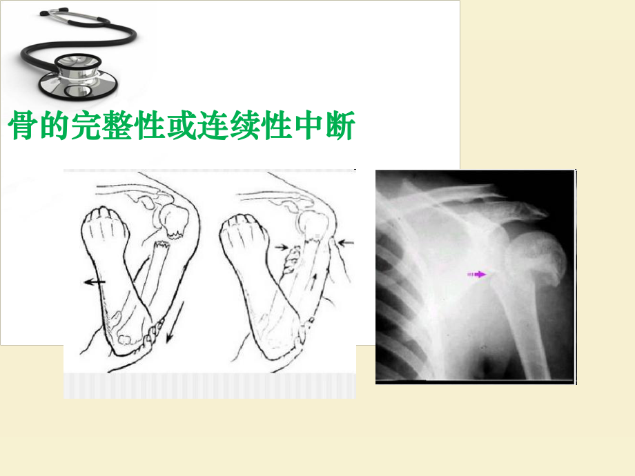 骨折-ppt课件.ppt_第2页