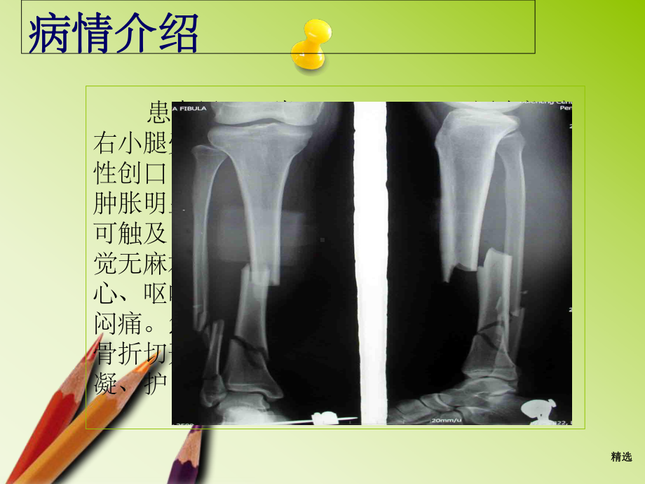 胫腓骨骨折的护理PPT课件.ppt_第2页