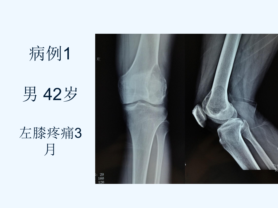 骨巨细胞瘤影像诊断-ppt课件.ppt_第2页