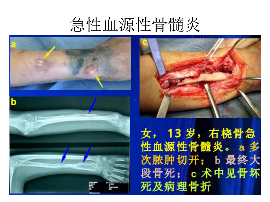 第68章-骨与关节化脓性感染课件.ppt_第3页