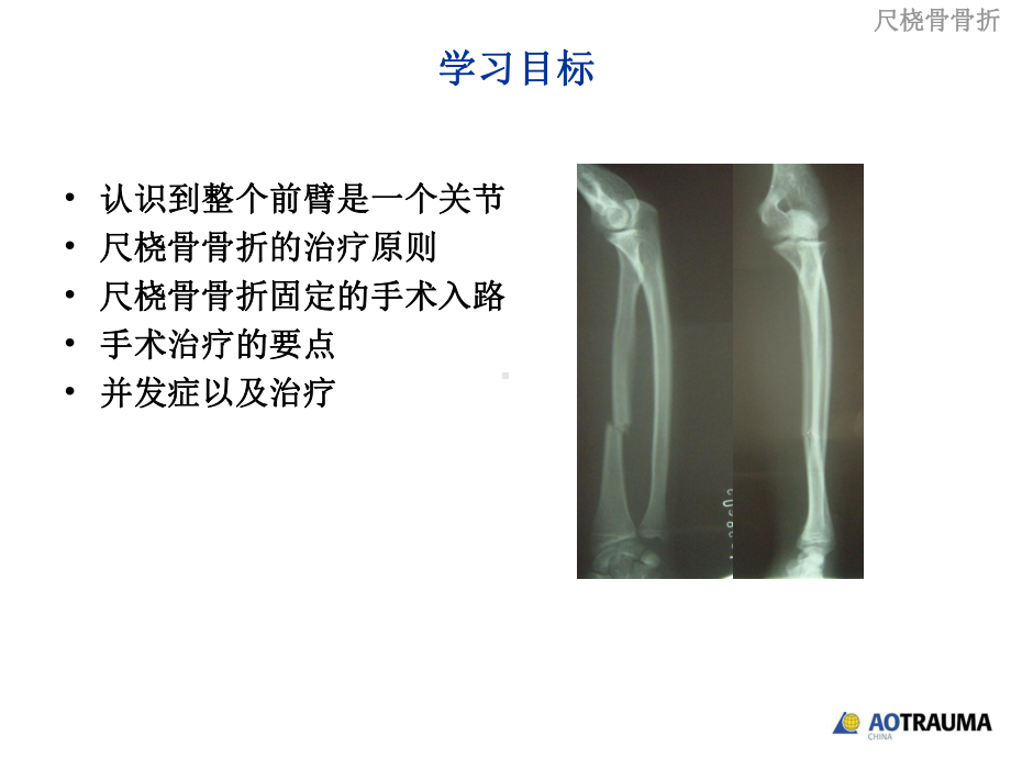 尺桡骨骨折手术原则-ppt课件.ppt_第2页