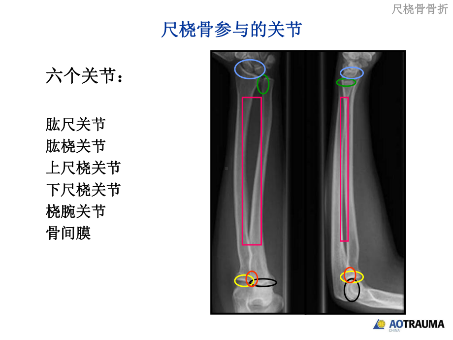 尺桡骨骨折手术原则-ppt课件.ppt_第3页