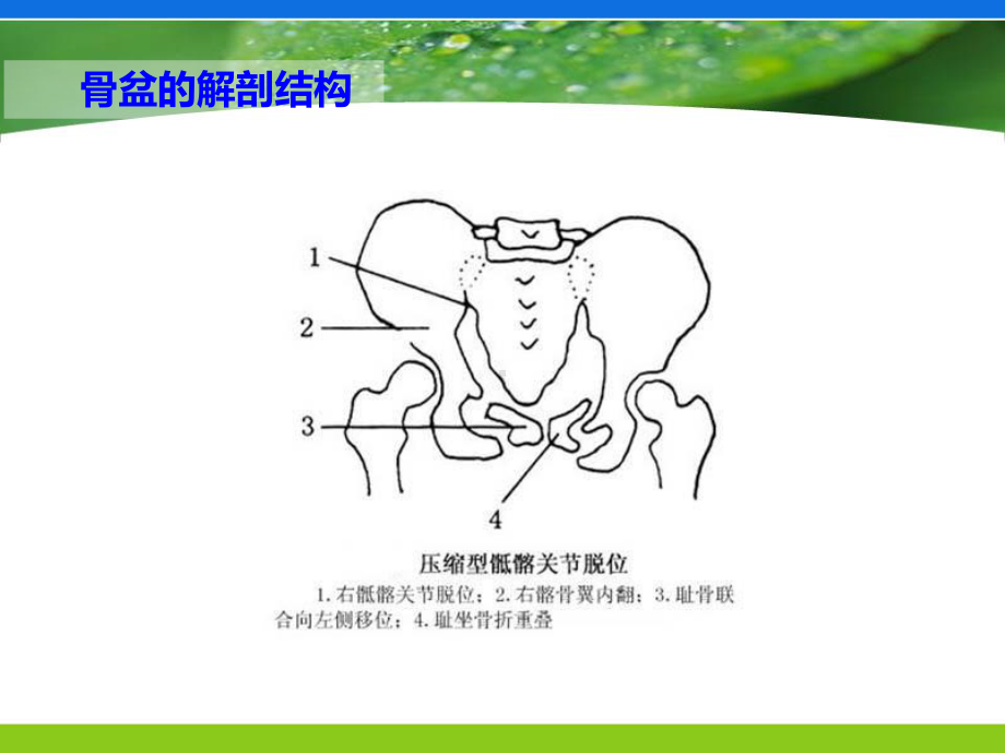 骨盆骨折急救与护理PPT课件.ppt_第2页