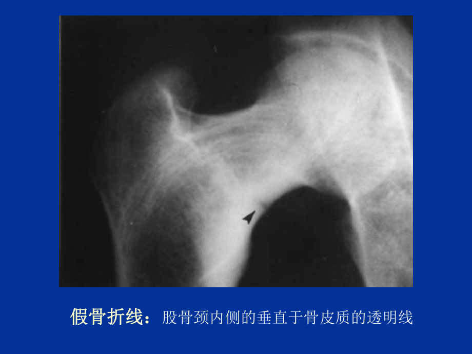 代谢性骨病4-ppt课件.ppt_第3页