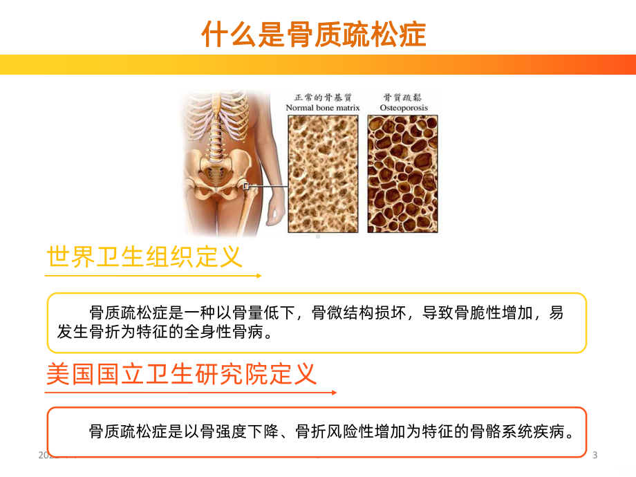 骨质疏松健康讲座PPT课件.ppt_第3页