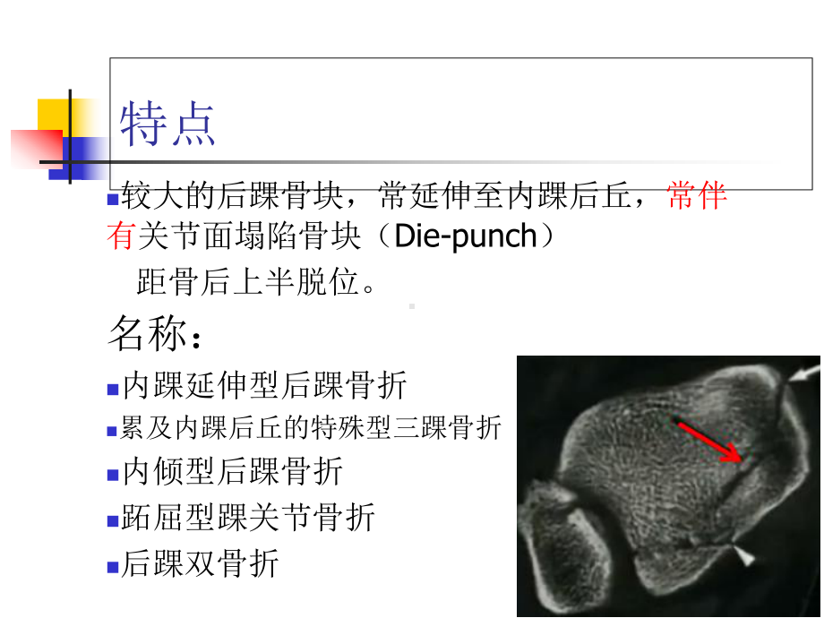 医学课件后pilon骨折足踝外科.ppt_第2页