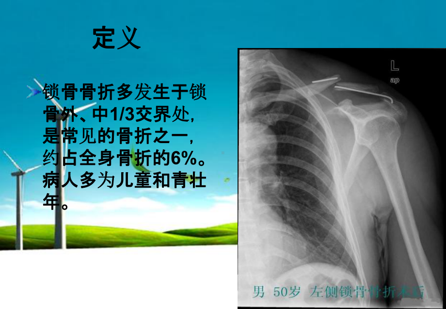 锁骨骨折的护理ppt课件.ppt_第2页