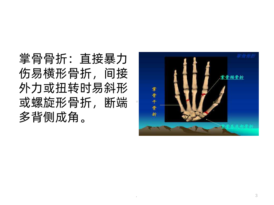 掌骨骨折ppt课件.ppt_第3页