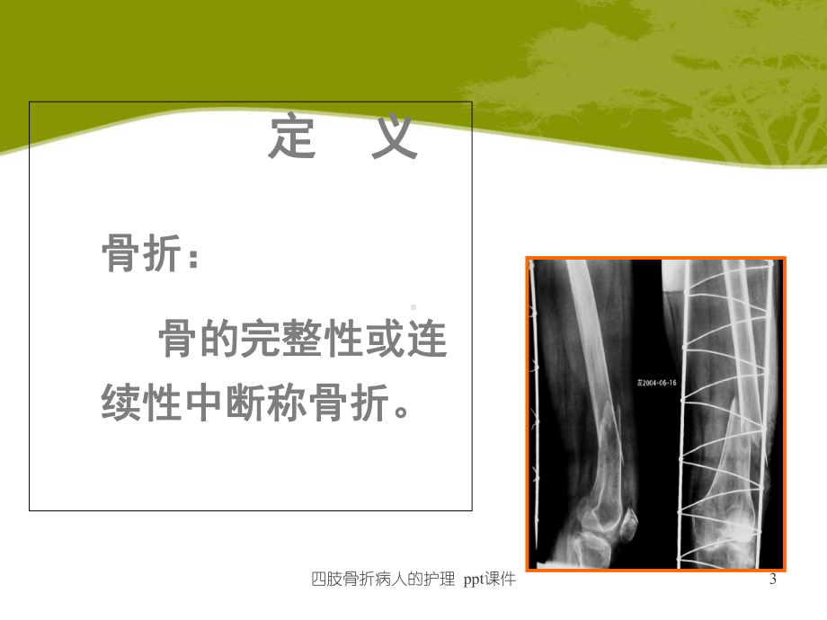 四肢骨折病人的护理-ppt课件.ppt_第3页