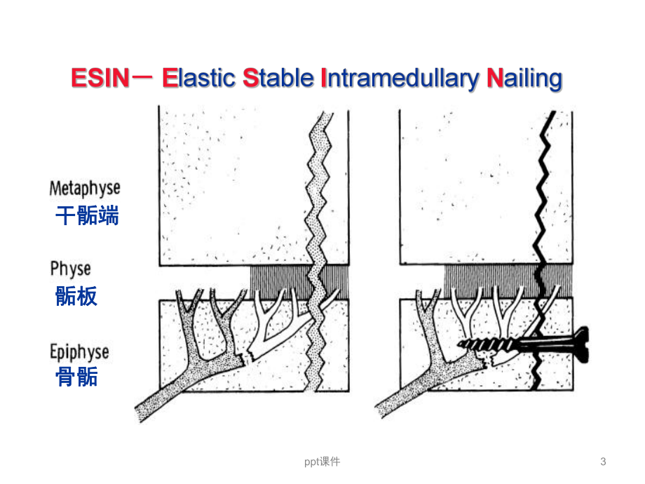 弹性髓内钉治疗儿童长骨骨折-ppt课件.ppt_第3页