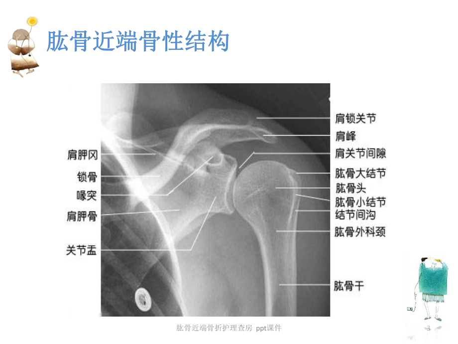 肱骨近端骨折护理查房-ppt课件.ppt_第3页