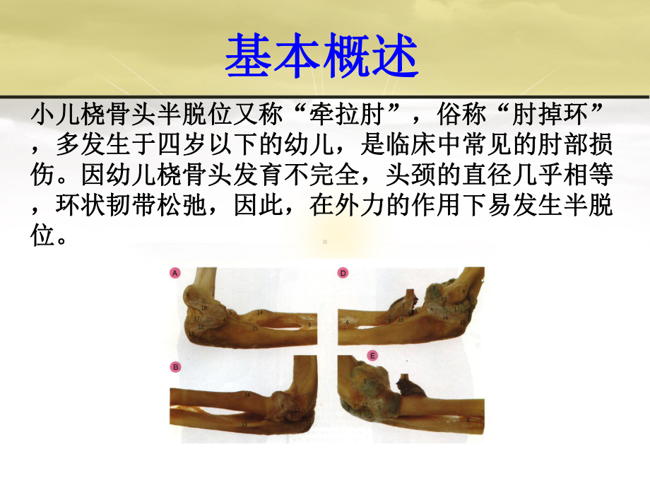 桡骨头半脱位(伤科学)课件.ppt_第2页