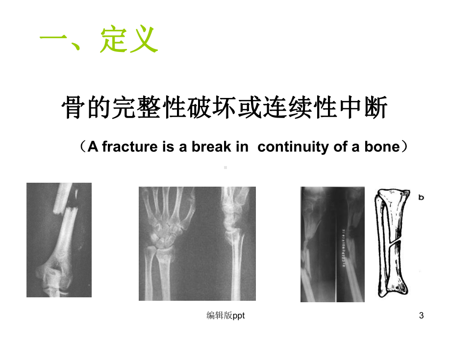 骨与关节损伤ppt课件1.ppt_第3页