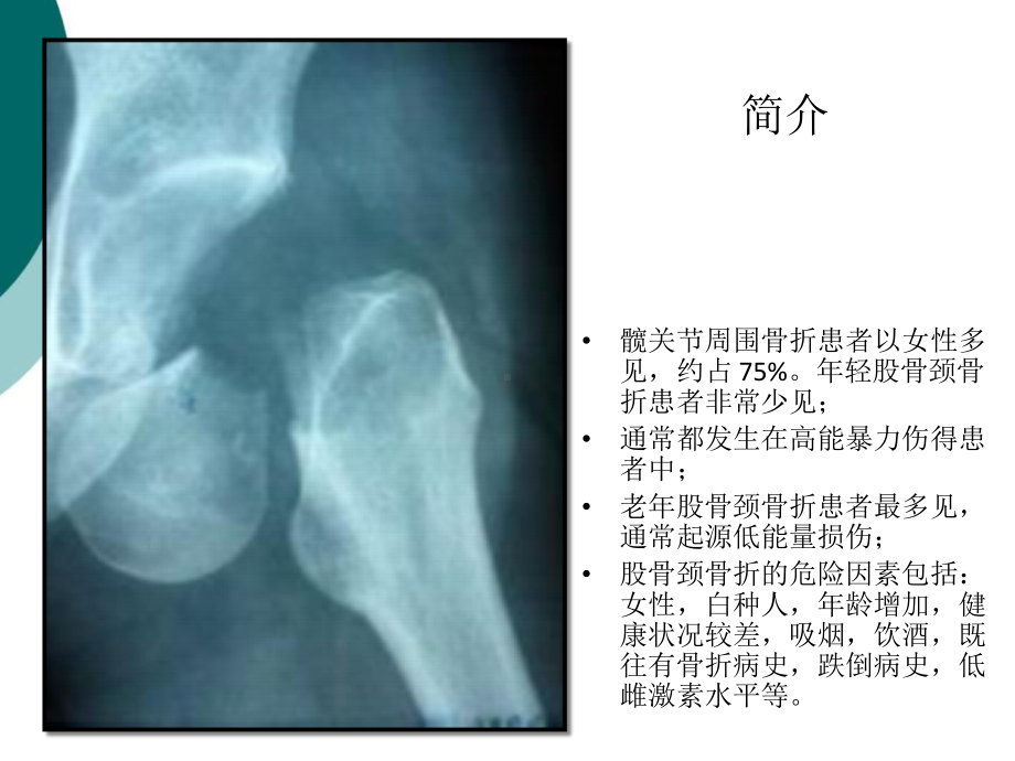 股骨颈骨折诊断与治疗课件.ppt_第3页