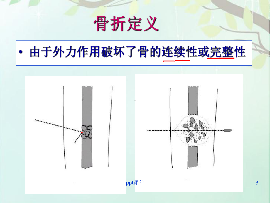 中医骨伤骨折概论-ppt课件.ppt_第3页