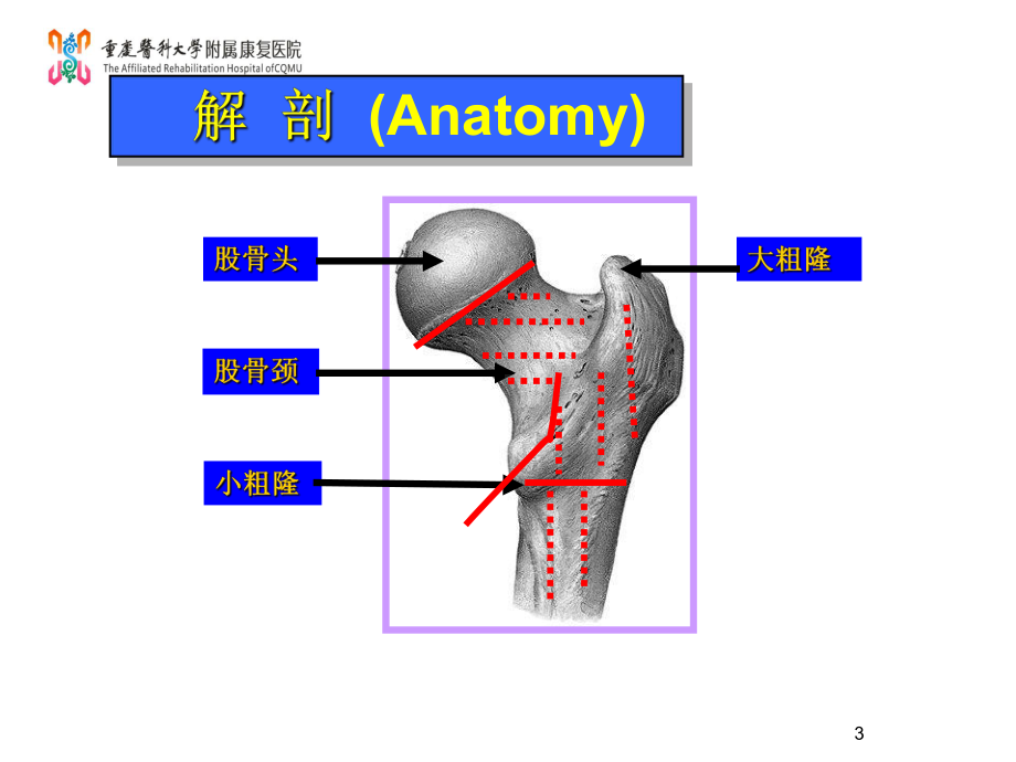 骨折病人的护理讲课PPT课件.ppt_第3页