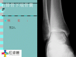 医学影像-骨肿瘤X线病例图谱(详细)课件.ppt