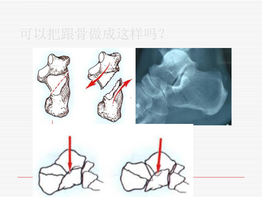 跟骨骨折ORIF的技巧课件.ppt_第3页