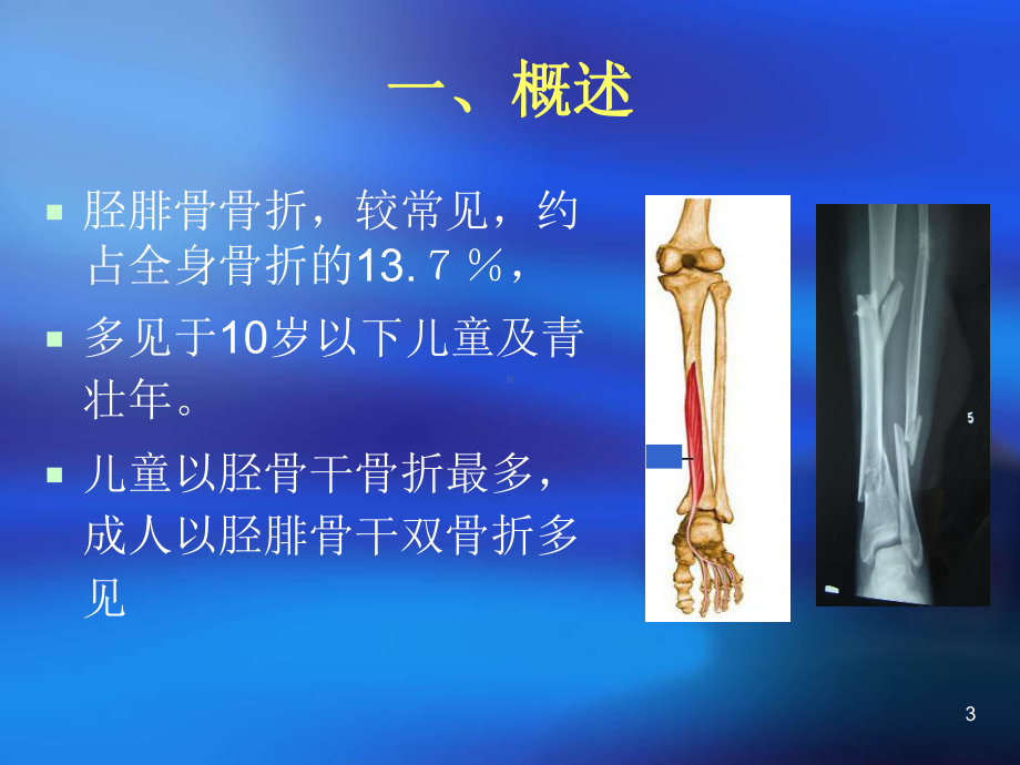 胫腓骨干骨折ppt课件.ppt_第3页