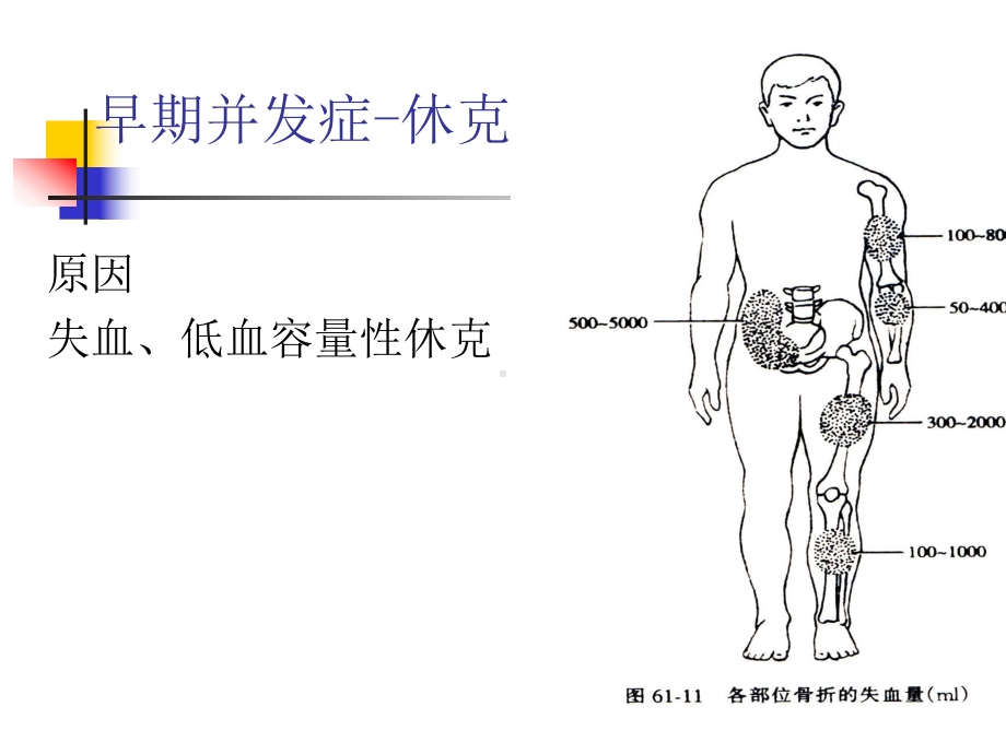 骨折并发症的护理-课件.ppt_第2页