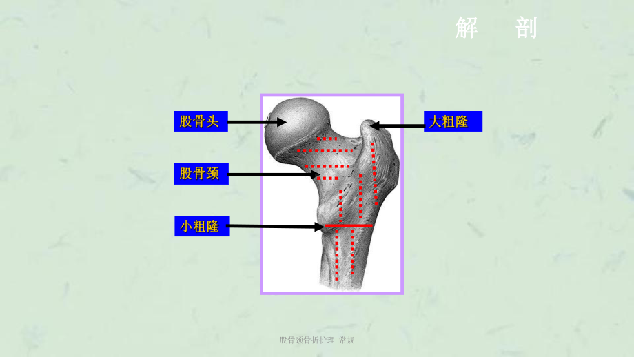 股骨颈骨折护理-常规课件.ppt_第3页