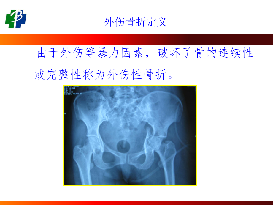 四肢骨折现场急救外固定技术ppt课件PPT.ppt_第2页