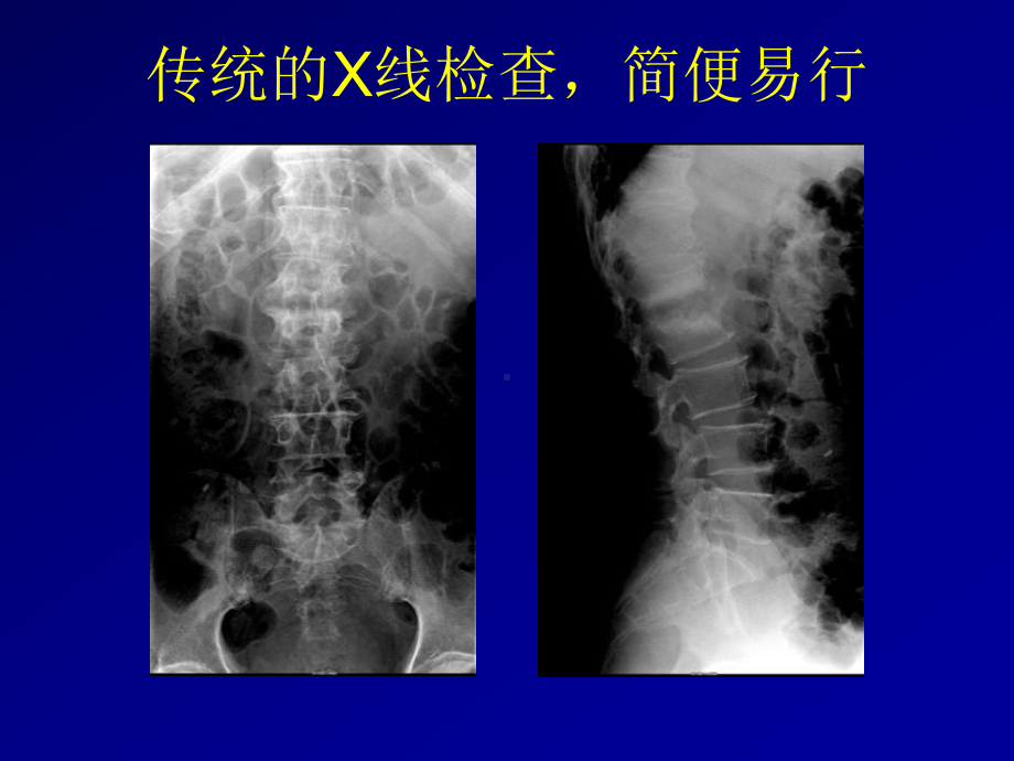 骨关节结核影像学诊断课件.ppt_第1页