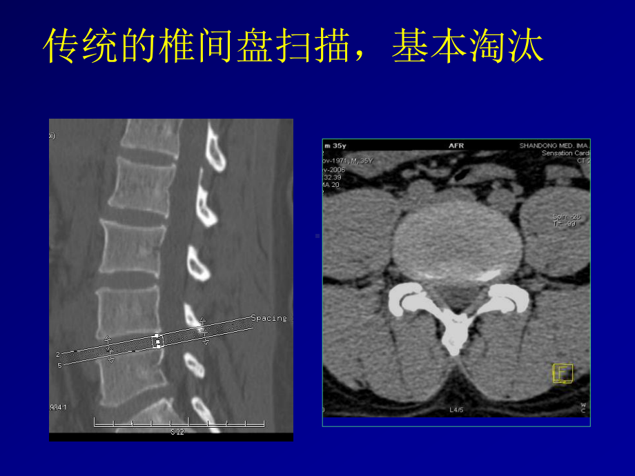 骨关节结核影像学诊断课件.ppt_第2页