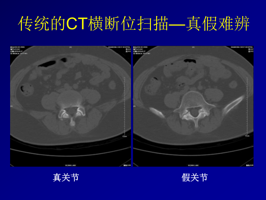 骨关节结核影像学诊断课件.ppt_第3页