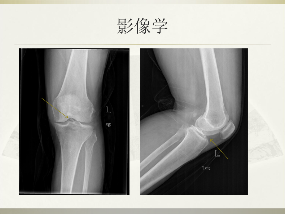 前交叉韧带胫骨止点撕脱性骨折课件.ppt_第3页