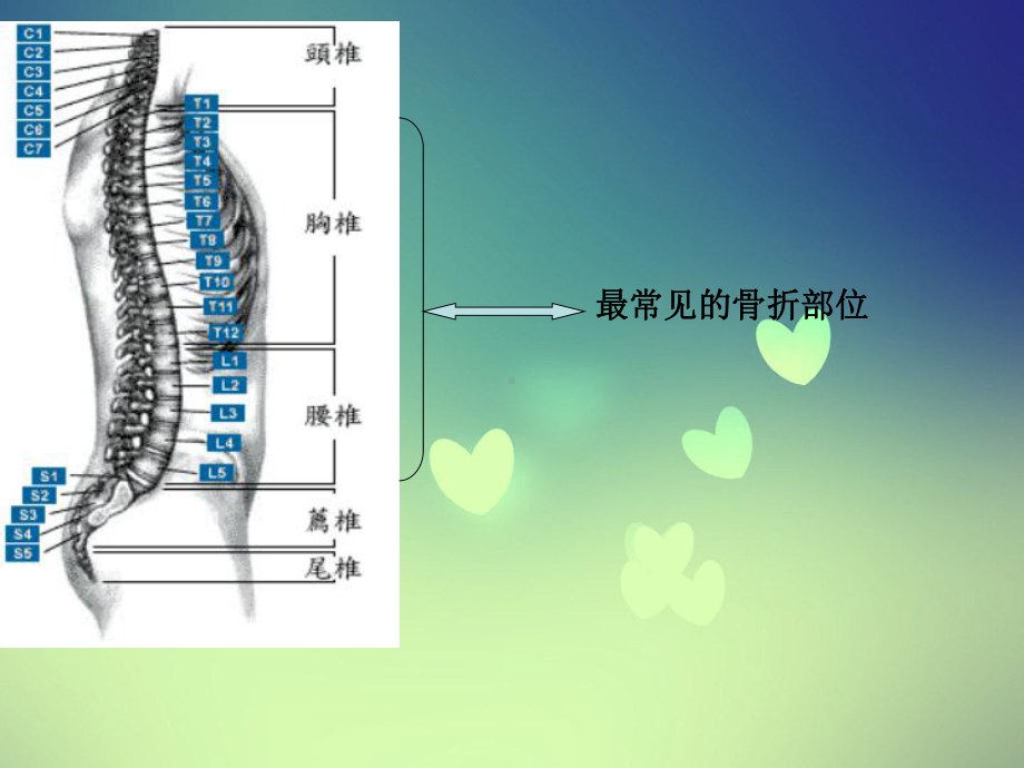 脊椎骨折病人的护理PPT课件.ppt_第2页