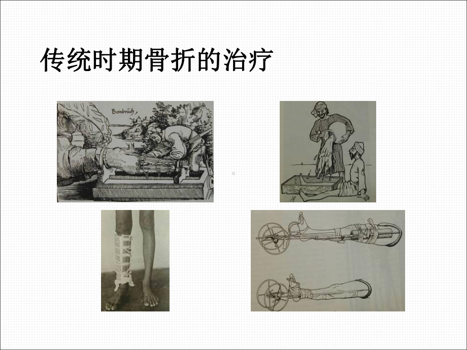 骨折治疗的AO原则与BO理念-ppt课件.ppt_第3页