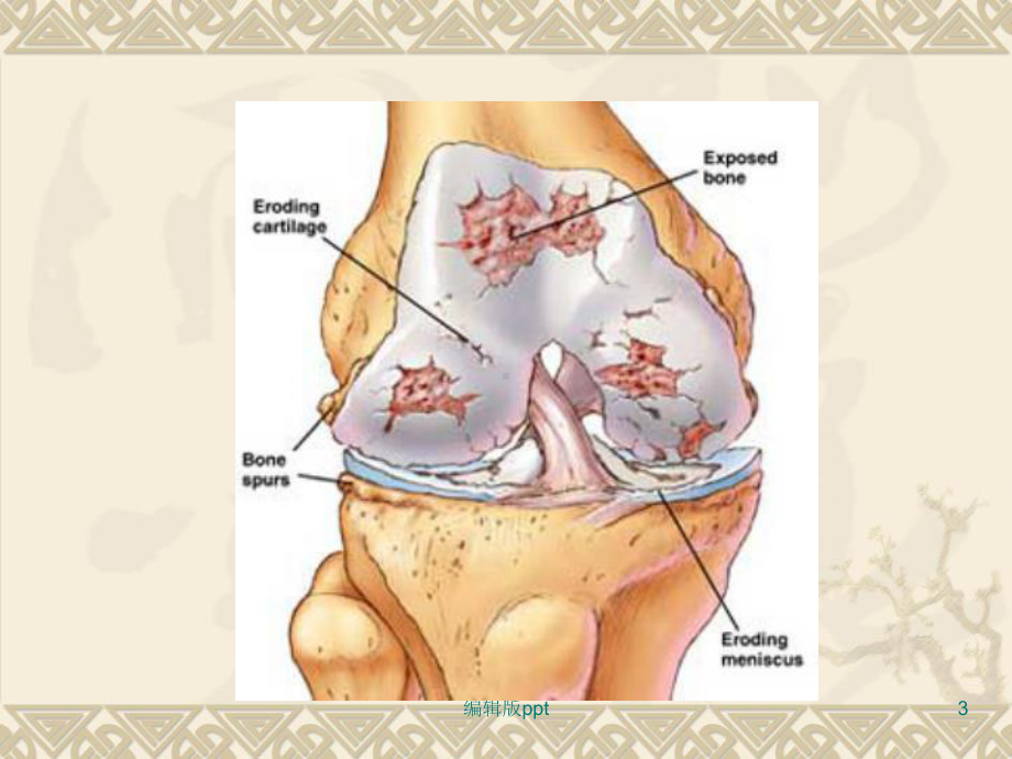 骨性关节炎临床和影像诊断PPT课件.ppt_第3页