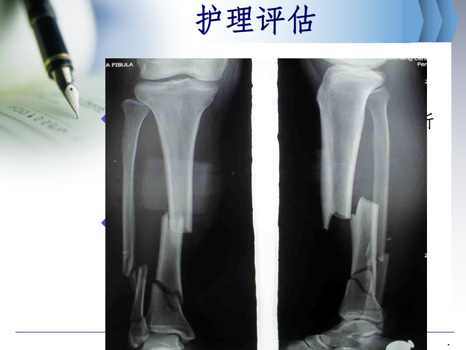 胫腓骨骨折护理查房ppt课件1.ppt_第3页