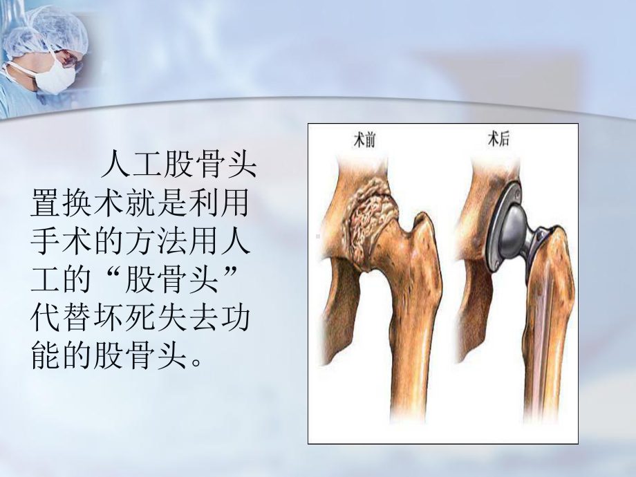 股骨头置换术围手术期护理课件.ppt_第2页