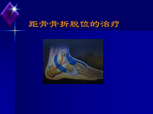 [临床医学]距骨骨折课件.ppt