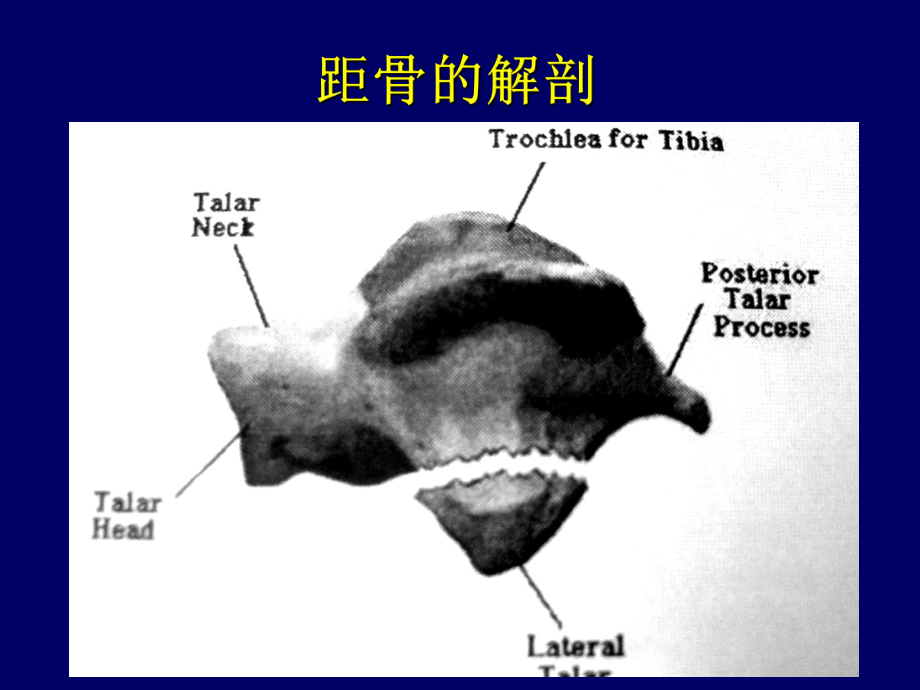 [临床医学]距骨骨折课件.ppt_第3页