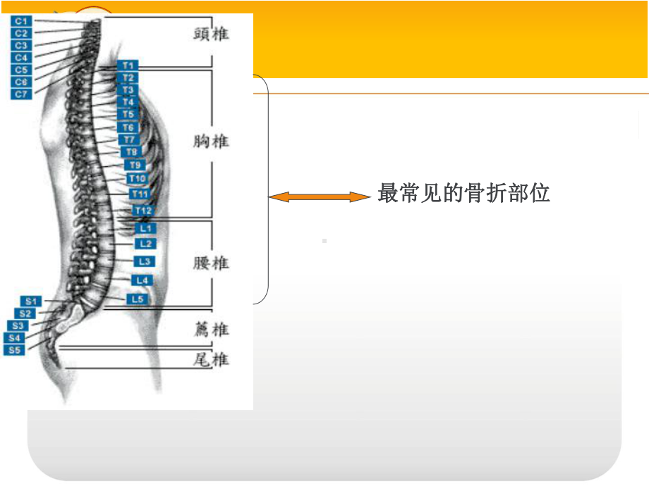 脊椎骨折病人的护理-ppt课件.ppt_第2页