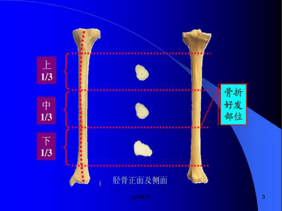 胫腓骨骨折-ppt课件.ppt_第3页