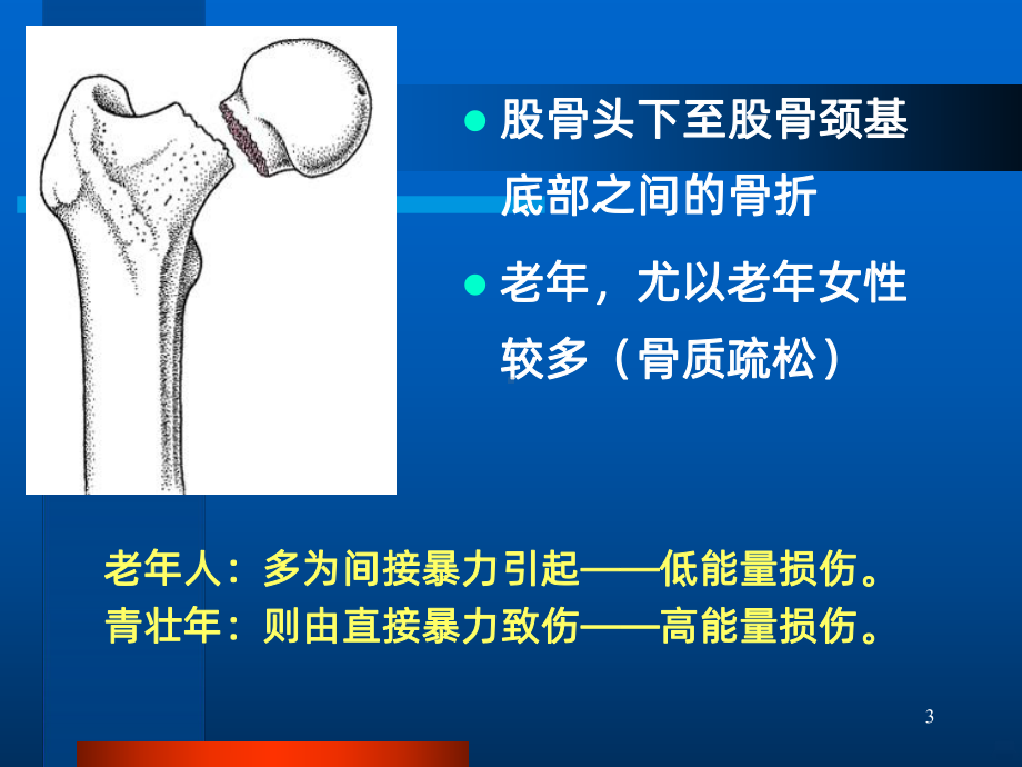 股骨颈骨折详解PPT课件.ppt_第3页