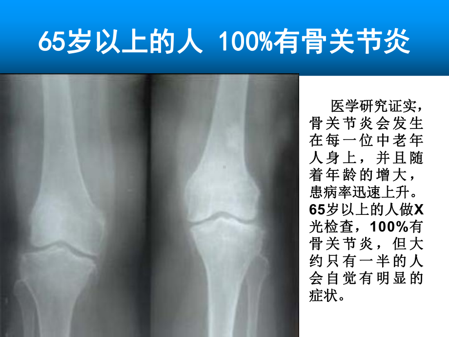 骨关节病知识ppt课件.ppt_第3页