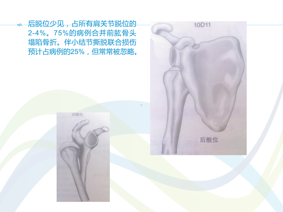 骨折与脱位诊断分型及治疗-ppt课件.ppt_第3页