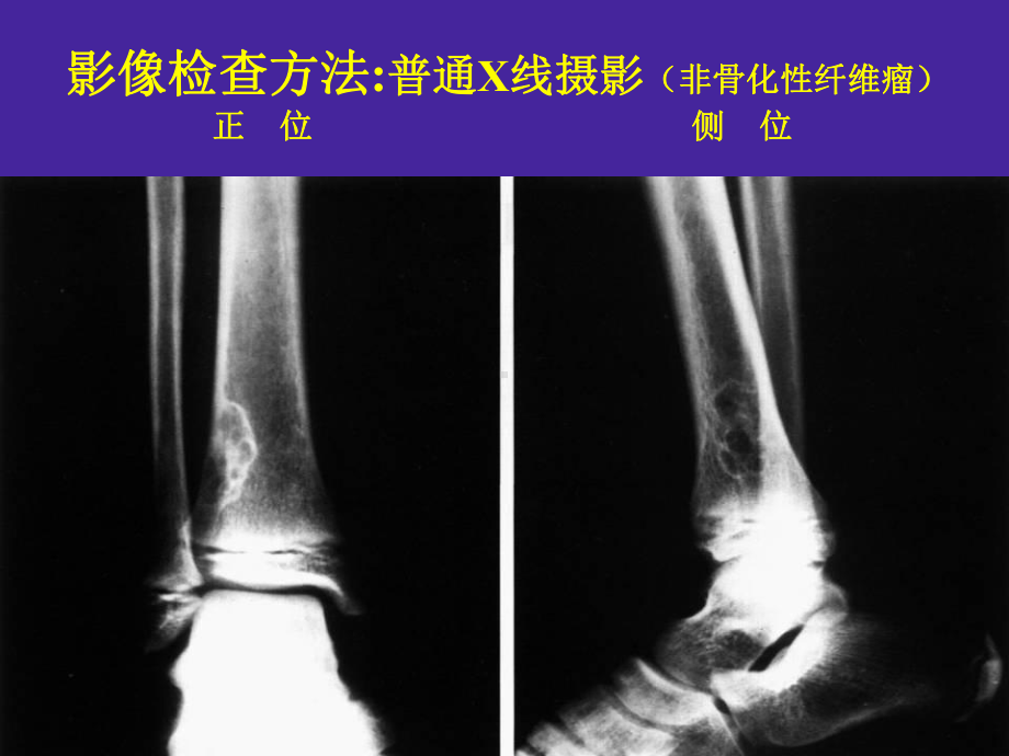 临床本科骨关节实习片库1课件.ppt_第3页