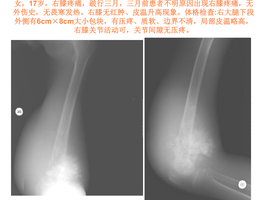 骨肉瘤X线诊断PPT课件.ppt_第3页