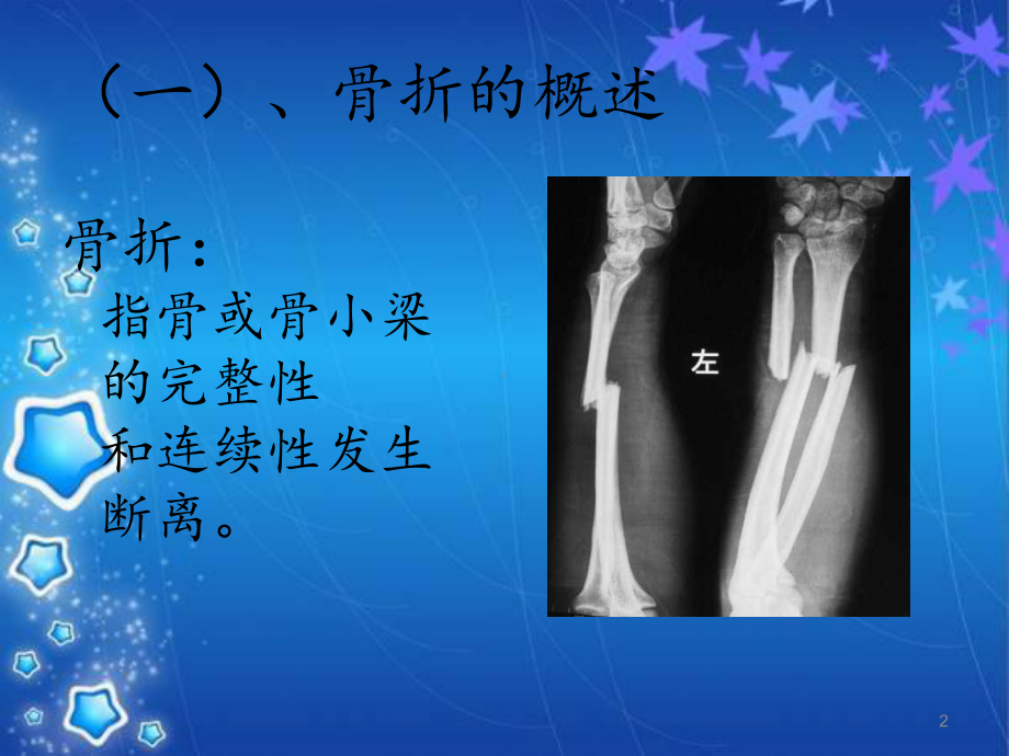 骨折术后康复PPT课件.ppt_第2页