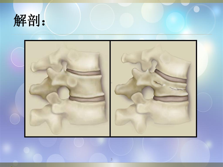 腰椎压缩骨折护理查房PPT课件.pptx_第3页