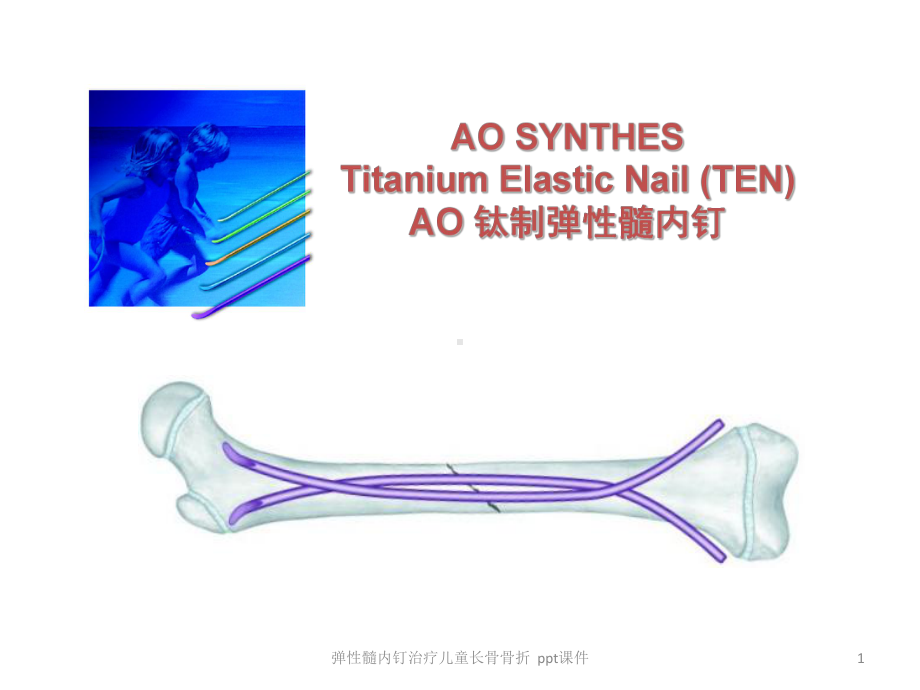 弹性髓内钉治疗儿童长骨骨折-ppt课件.ppt_第1页