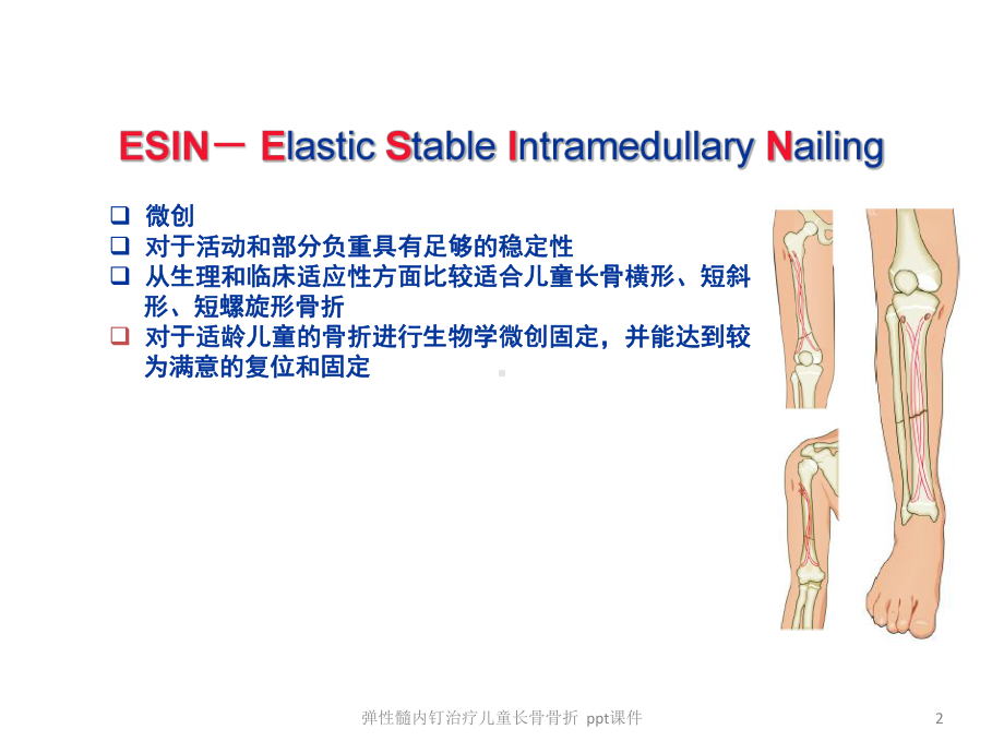 弹性髓内钉治疗儿童长骨骨折-ppt课件.ppt_第2页